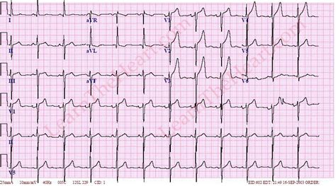 left ventricular enlargement ecg